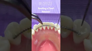 Bonding a Fixed Retainer