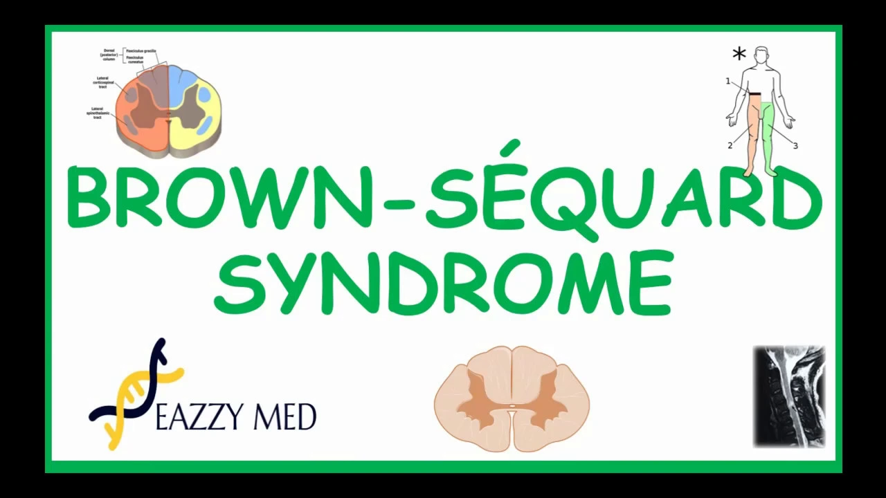 Brown-Sequard Syndrome causes, pathophysiology, symptoms diagnosis and treatment