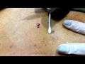 Age Spot removal at Ultimate Aesthetic Beauty Salon Subiaco