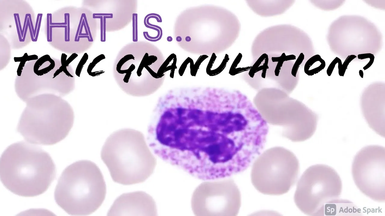Toxic Granulation of Neutrophils: Causes and Hematopathology