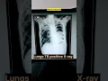 Download Lagu Chest X-ray Normal vs Abnormal  #shorts