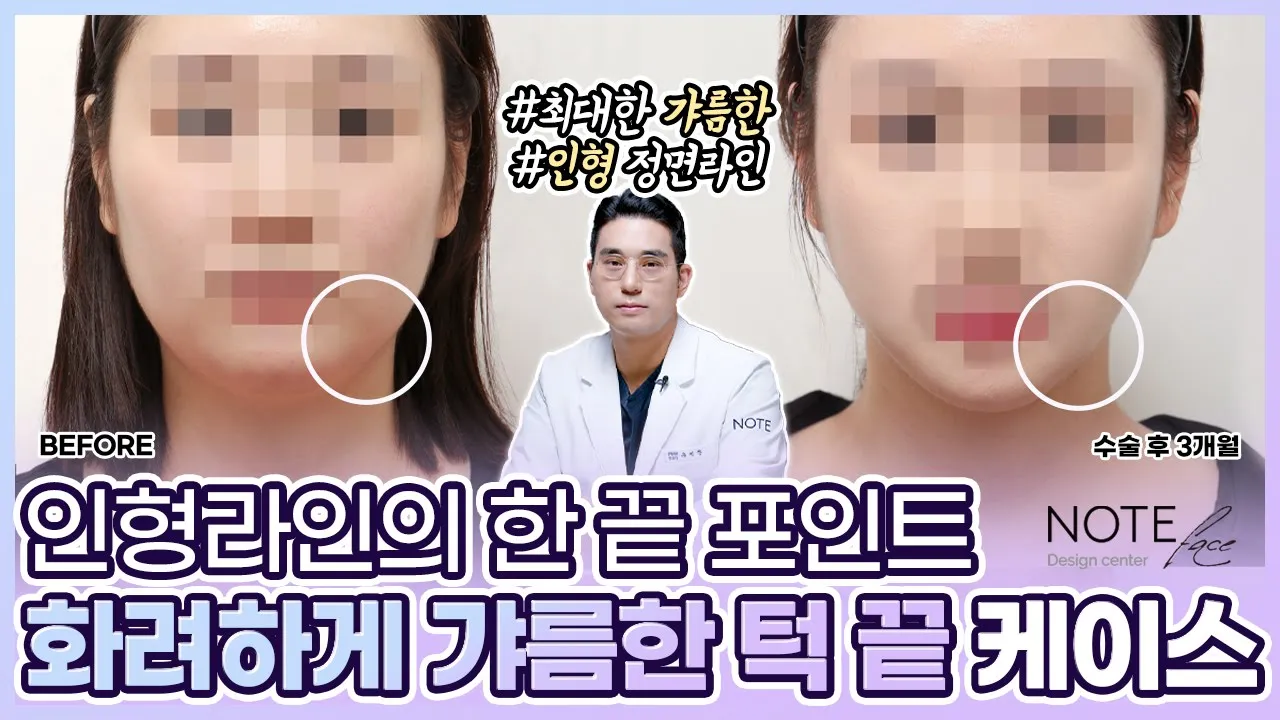 [유.케.리] 📍 CT로 보는 케이스 리뷰 l 턱 - 사각턱 라인 l 인형라인 l
