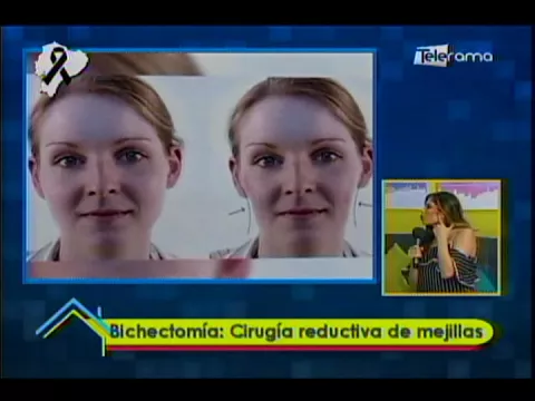Bichectomía: Cirugía reductiva de mejillas