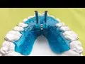 Download Lagu Vorschubdoppelplatte, Angle 2, Sander 2, Doppel-Vorschubplatte, Double Plate, KFO, Orthodontics