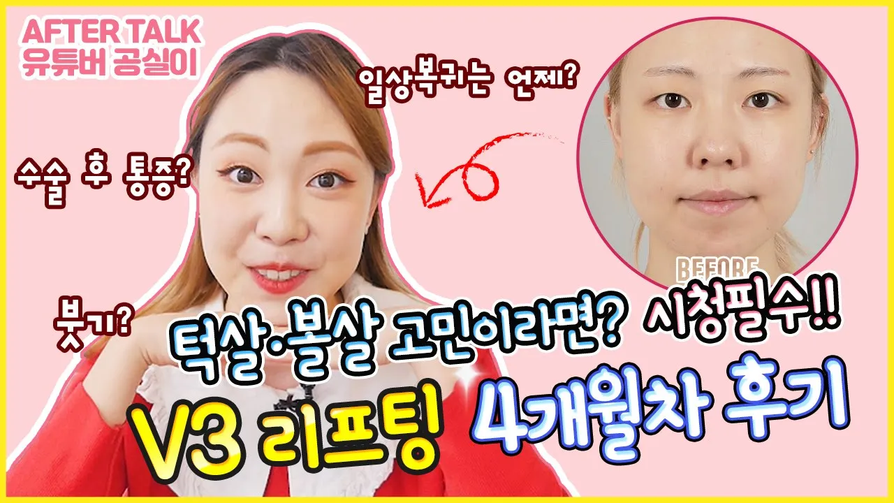 [실리프팅 후기 4개월차] 뷰티 유튜버 공실이의 V3 리프팅 애프터 공개!┃수술 후 부작용? 통증? 일상생활 가능기간?
