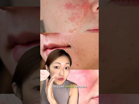 Retinol Ruined Your Skin? We’ll Fix It! (Free Routine Box)