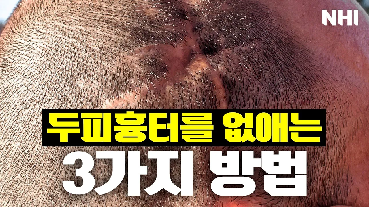 두피 흉터를 없애버리자! - 뉴헤어 I 모발이식 I 두피문신