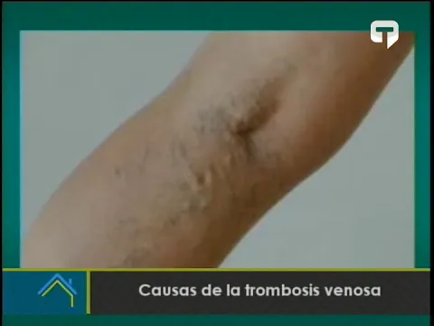 Causas de la trombosis venosa