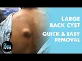 Dr Pimple Popper vs The Large Back Cyst A Clean Removal from Start to Finish