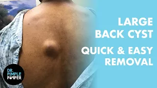 Dr Pimple Popper vs The Large Back Cyst A Clean Removal from Start to Finish