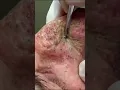 Download Lagu This is one of the videos that really kicked off this whole Dr  Pimple Popper phenomenon 🙌