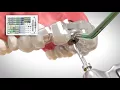 Guided Surgery from BioHorizons