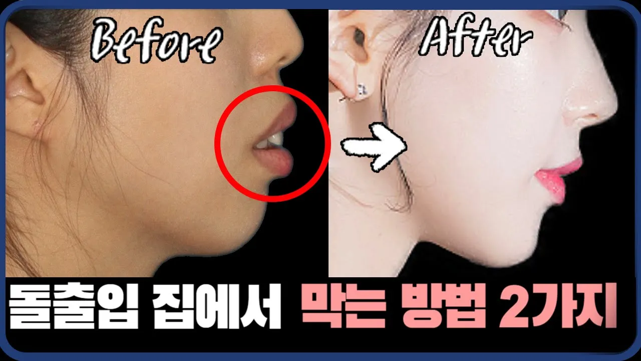 ()치과 안 가고 돌출입 막는 방법 2가지 ㅣ 강남 치과 원장이 알려드립니다..#돌출입 #돌출입교정