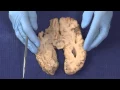 Download Lagu Basal Ganglia: Neuroanatomy Video Lab - Brain Dissections