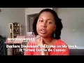 Doctors Dismissed the Lump on My Neck for 5 Years It Turned Out to Be Cancer Misdiagnosed Health