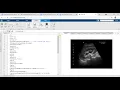 kidney stone detection using digital image processing