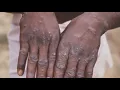 Newsom declared state of emergency amid monkeypox spread across California