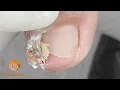 Download Lagu I proceed very carefully to decompress the area and remove the spicule | Onychocryptosis + granuloma
