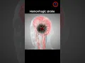 Download Lagu The goal of Treat Hemorrhagic stroke ,, #stroke #bleeding