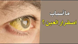 ما أسباب اصفرار العين 