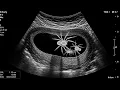 Fake Ultrasound Prank