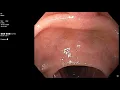 Download Lagu SLIM bypass, duodenal papilla palpation