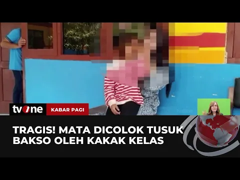Siswi di Gresik Buta Akibat Dicolok Tusukan Bakso oleh Kakak Kelas