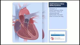 WPW Wolff Parkinson White Syndrome Animation Video 