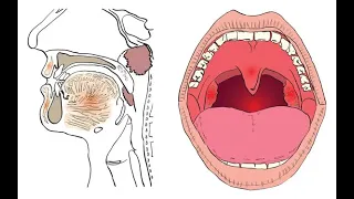 Tonsillectomy Adenoidectomy Branchial cleft cyst Pharyngostomy Dr Rams Medical Coding Academy