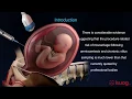 UOG abstract Risk of miscarriage following amniocentesis or chorionic villus sampling