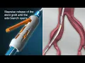 Download Lagu JOTEC E-liac Stent Graft System