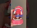 WHAT TO DO IF YOU RE BITING DOWN ON YOUR BRACES