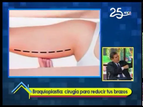 Braquioplastia: Cirugía para reducir tus brazos