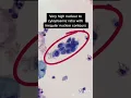 High grade dysplasia HSIL severe on a Pap smear