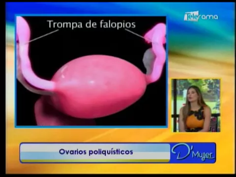 Ovarios poliquísticos