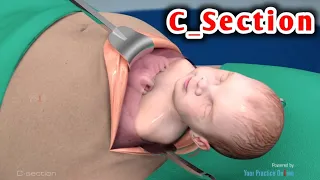 شاهد الولادة الطبيعية والولادة القيصرية وحدد ايهما افضل Watch Caesarean Section And Natural Birth 