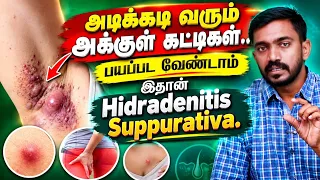 அக்குள் தொடை இடுக்குகளில் வரும் கட்டிகள் காரணம் தீர்வு Hidradenitis suppurativa in Tamil | #drsj