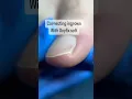 Pain-free ingrown nail fix