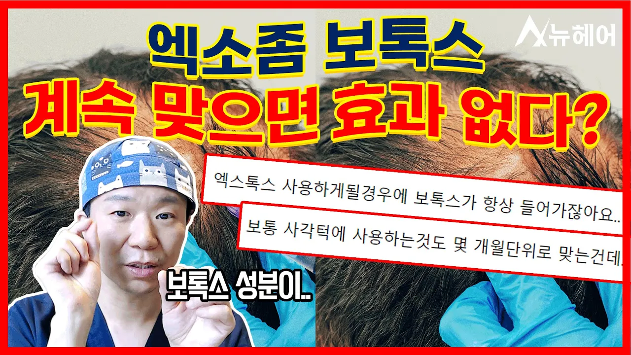 엑소좀 보톡스 탈모치료 장기간 받으면 생기는 일?ㅣ뉴헤어