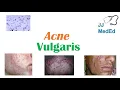 Acne Vulgaris Causes Pathogenesis Influencing Factors Diagnosis Treatment and Complications