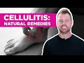 Stop Recurring Cellulitis 4 Proven Home Remedies for Natural Healing