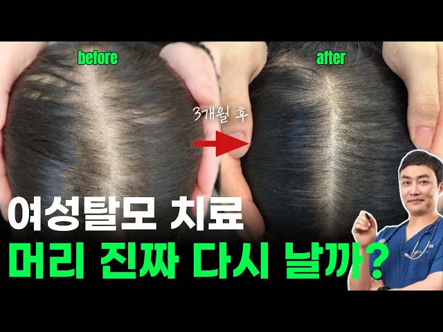 여성탈모 원인과 치료법 총정리 (feat.바르는 미녹시딜, 먹는 미녹시딜, 모낭줄기세포주사)