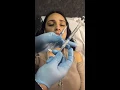 Dr Verduzco Lips inyection Juvederm Tijuana