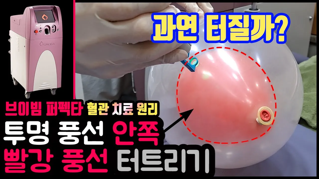 브이빔 퍼펙타 선택적 혈관치료 원리! 풍선속 풍선 터트리기로 알려드립니다.