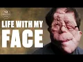 I Had Over 30 Surgeries To Remove Tumours Growing On My Face Minutes With ladbiblestories