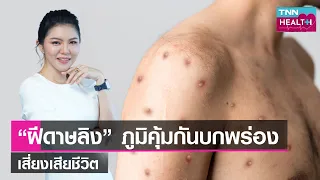 โรคฝีดาดลิงเกิดจากสาเหตุอะไร