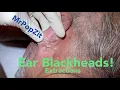Ear Blackhead extractions Multiple techniques used for deep embedded dry plugs and cyst pops