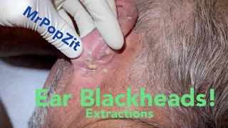Download Ear Blackhead extractions. Multiple techniques used for deep embedded dry plugs and cyst pops. MP3