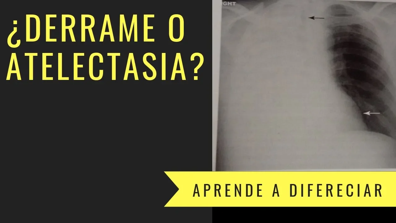 ¿Cómo diferenciar un derrame pleural de atelectasia?
