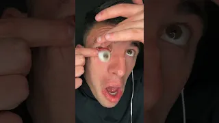 MY EYEBALL POPPED OUT 